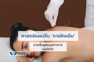 การฝังเข็ม ศาสตร์แผนจีนที่ช่วยฟื้นฟูสมดุลสุขภาพร่างกายและจิตใจ